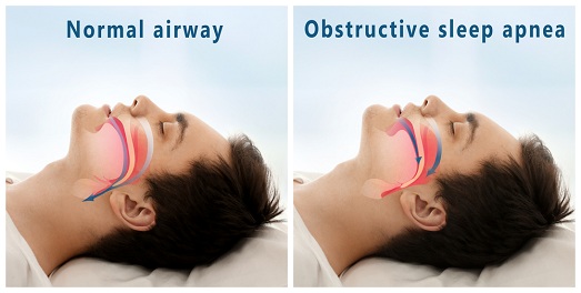 is sleep apnea deadly